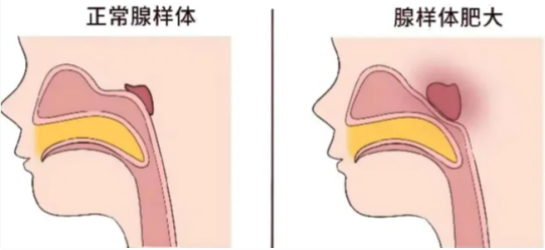 海迪生：扁桃体与腺样体肿大：揭秘它们之间的健康“纠葛”