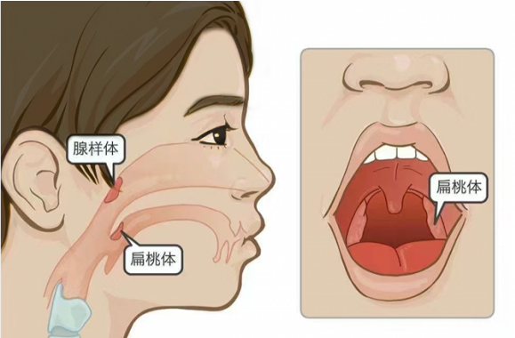 海迪生：谣言粉碎机——总发炎的扁桃体，要嘎掉？